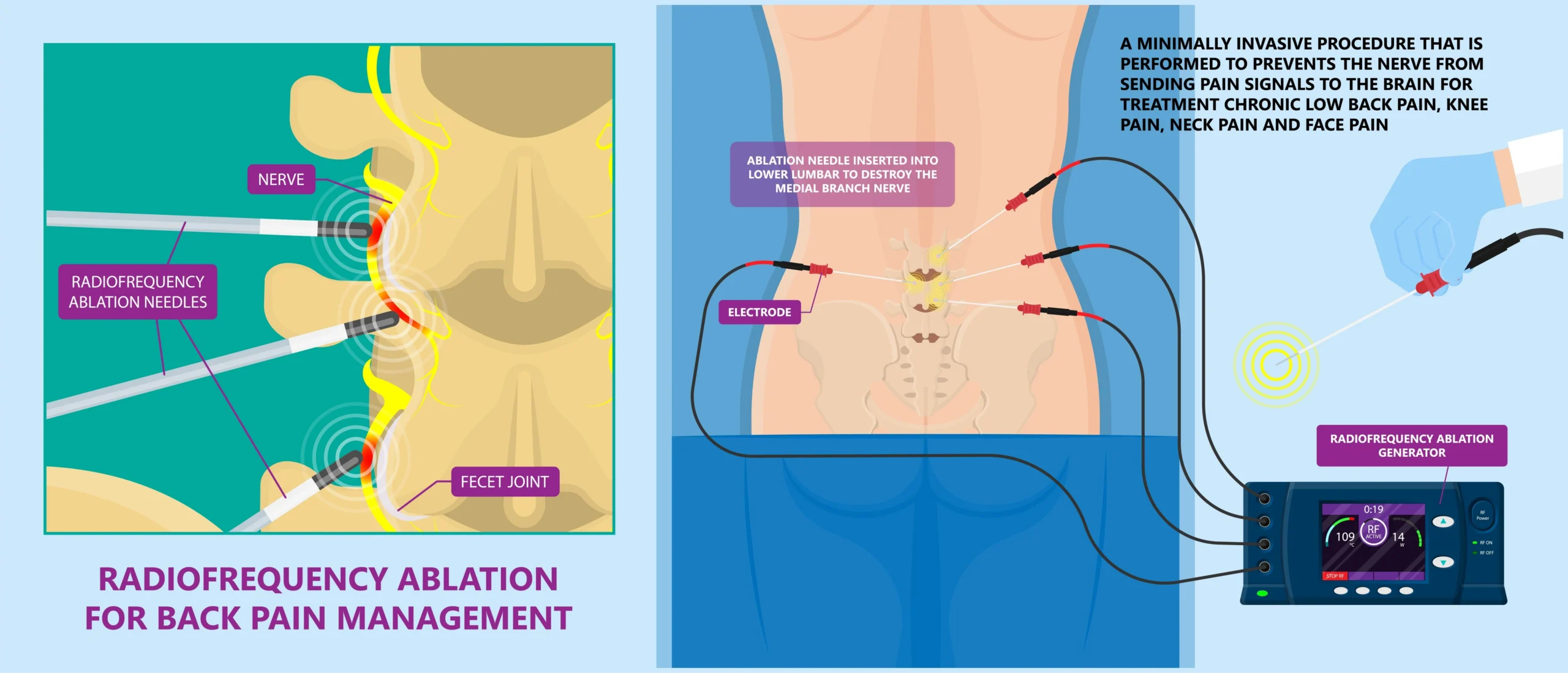 Medical illustration of radiofrequency ablation needles used to treat nerves associated with back pain.