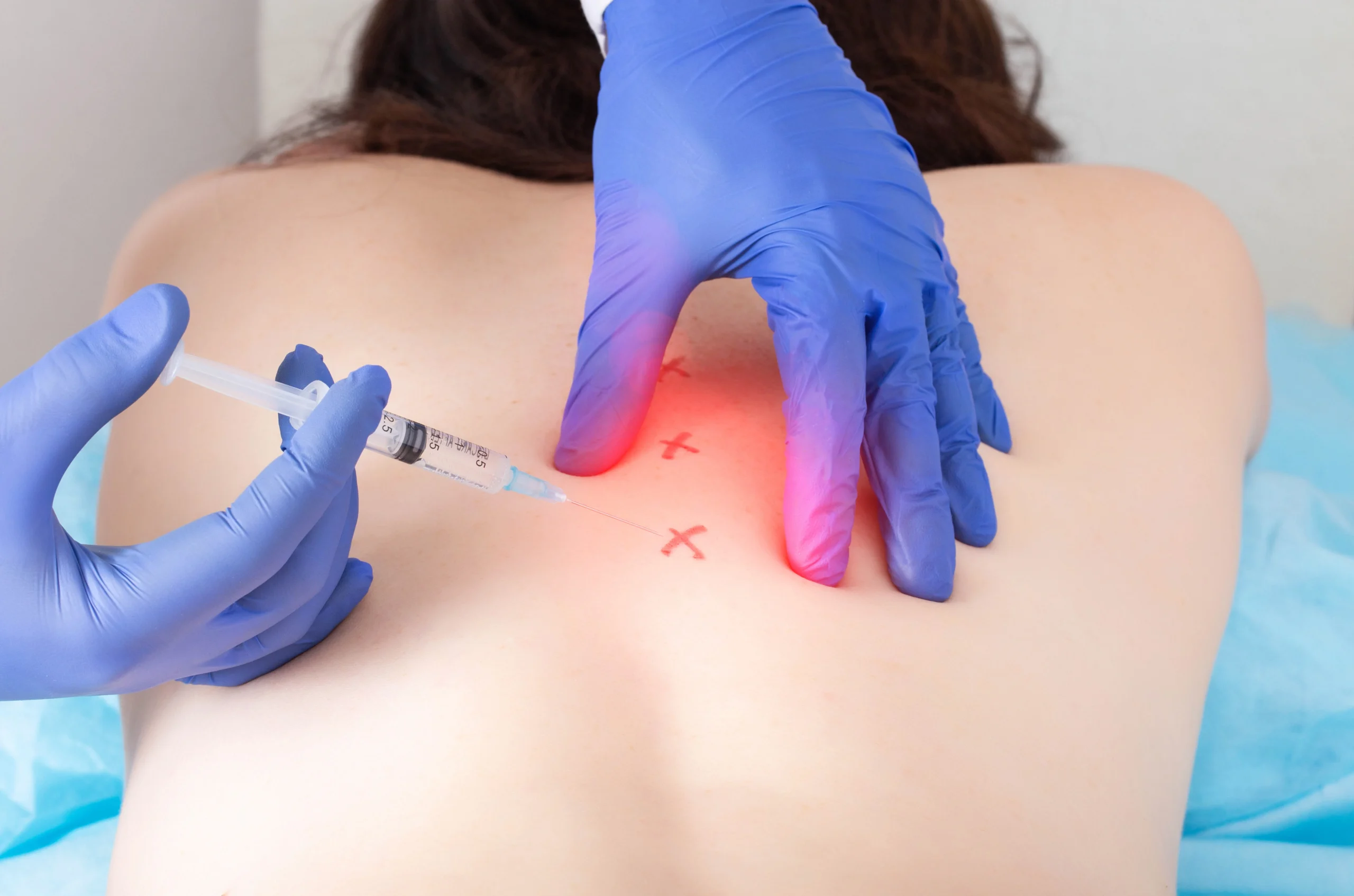 Medical provider performing trigger point injections at marked areas of a patient’s upper back.