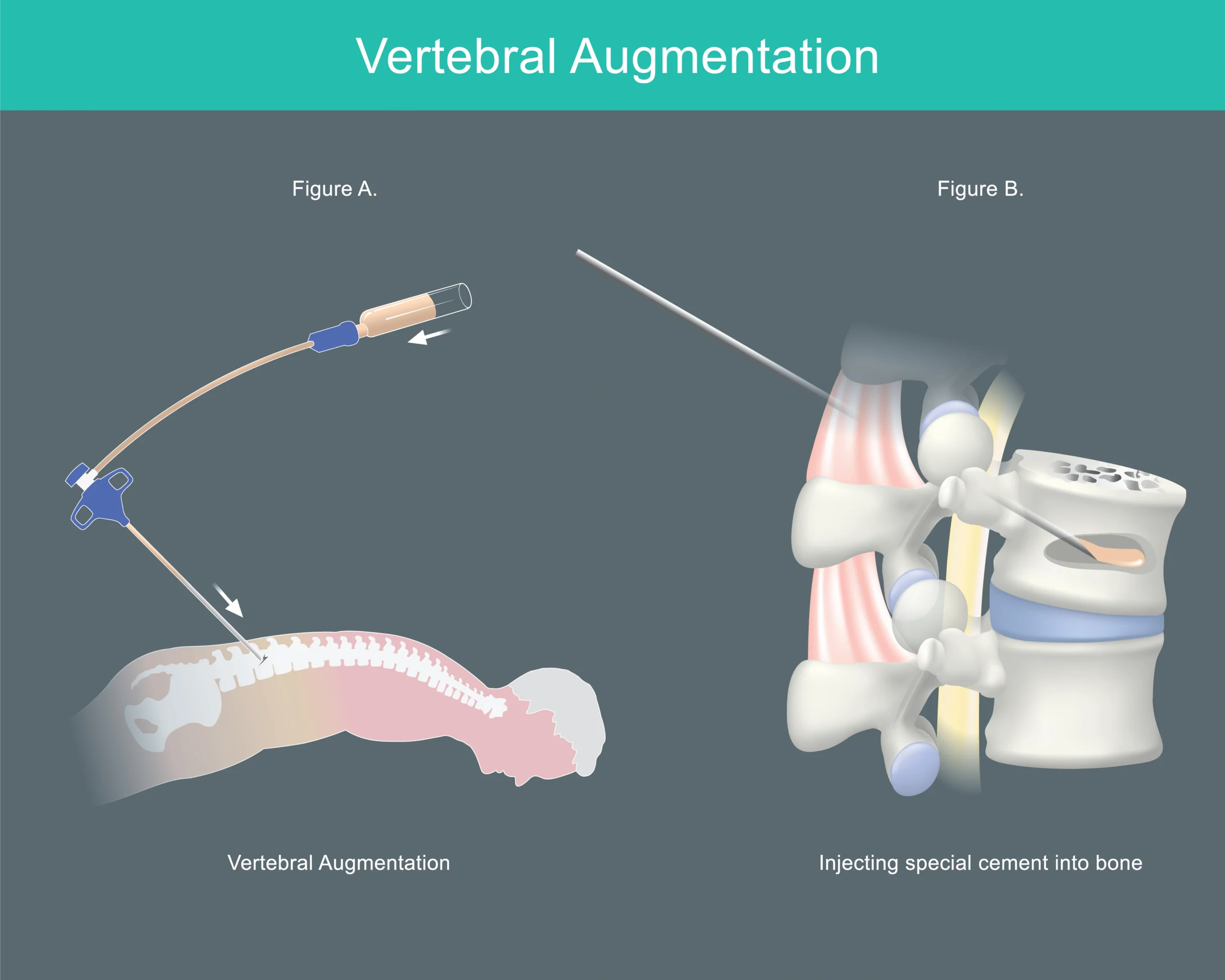 Medical illustration showing vertebral augmentation and the injection of bone cement into a fractured vertebra.